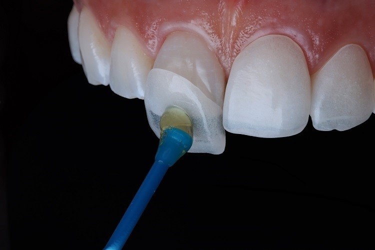 Porcelain Veneers in Lucknow