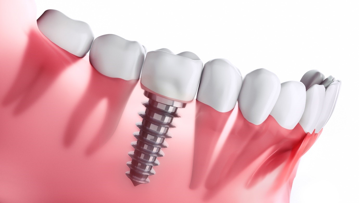 dental implant in lucknow