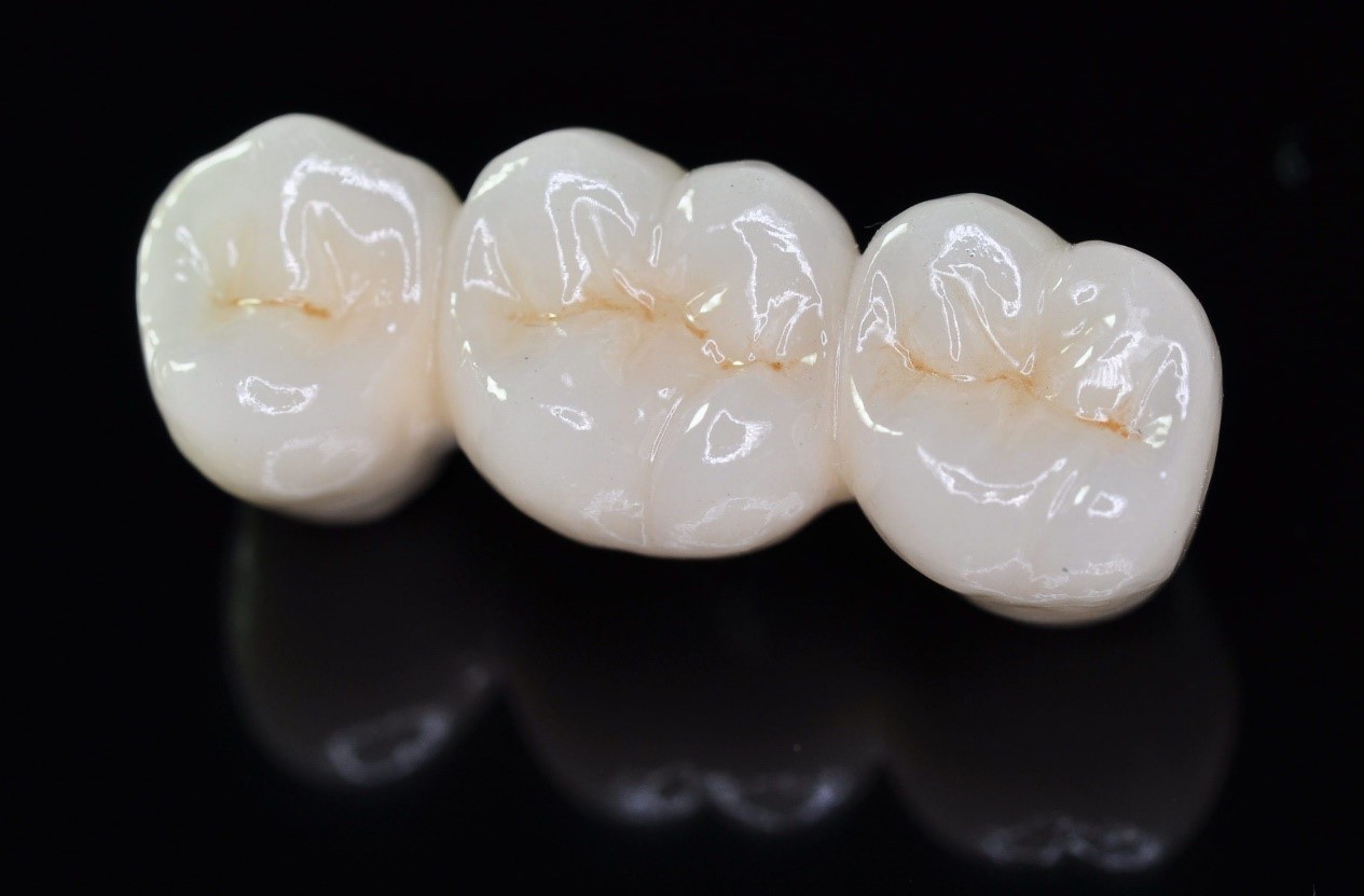 Dental Crowns and Bridges in Lucknow