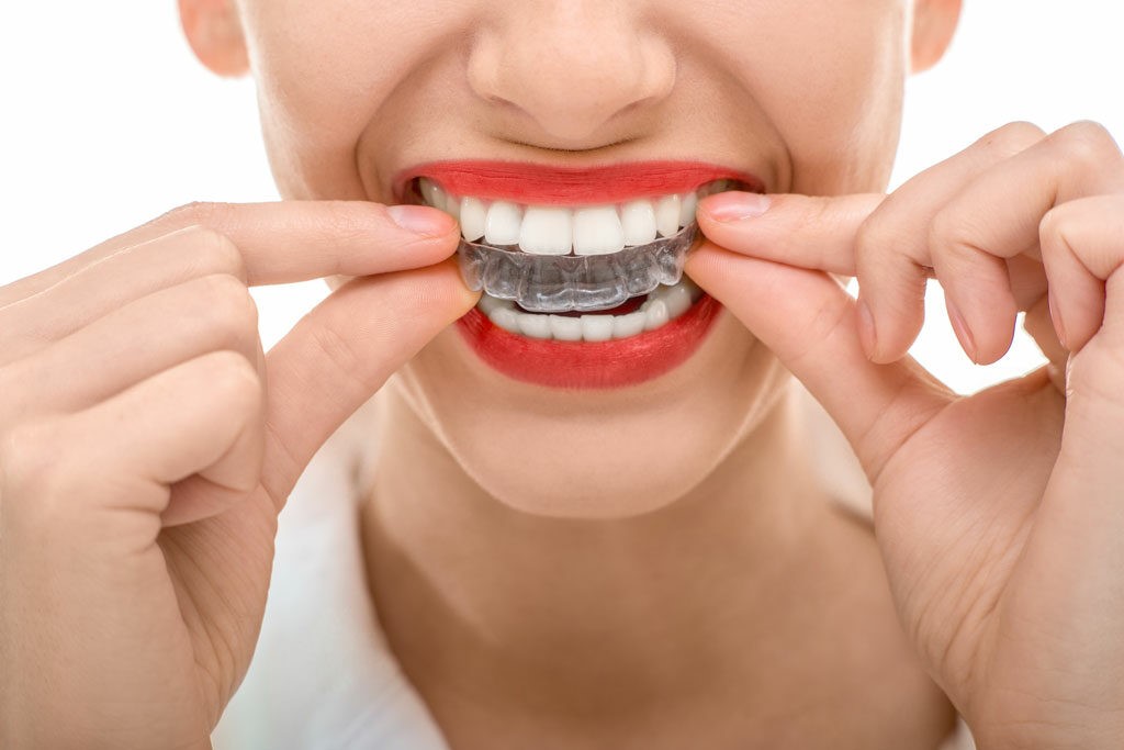 Clear Aligner in Lucknow
