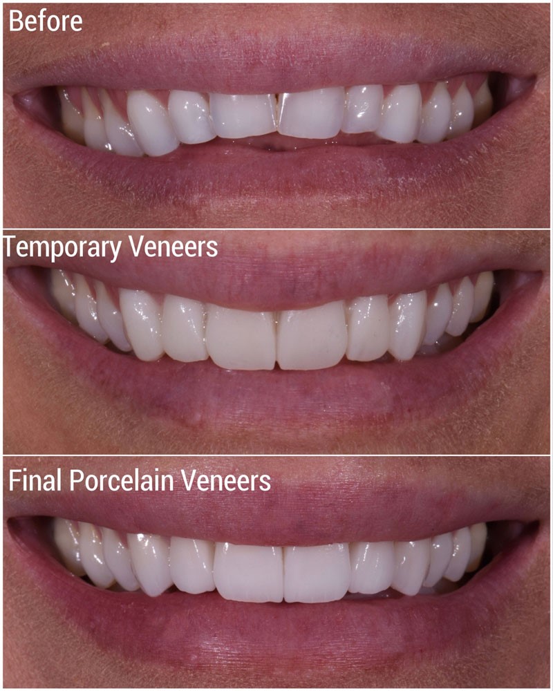 Clear Aligners Invisible Braces Cost In Lucknow