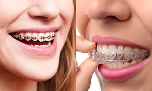 Clear Aligner in Lucknow
