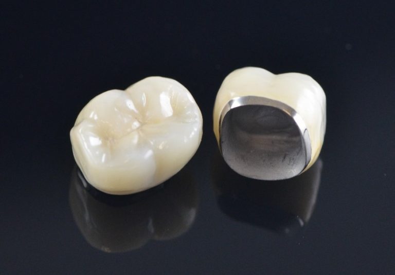 Best Dental Crown & Bridges Clinic in Lucknow Mint Dental