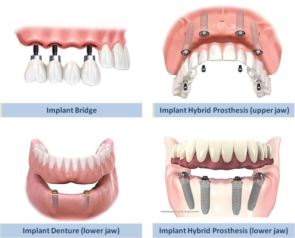 Dental Implant treatments