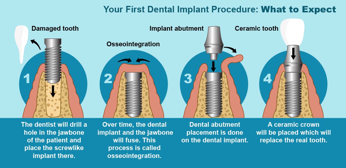 What is a Dental Implant? Best Dental Clinic in Lucknow