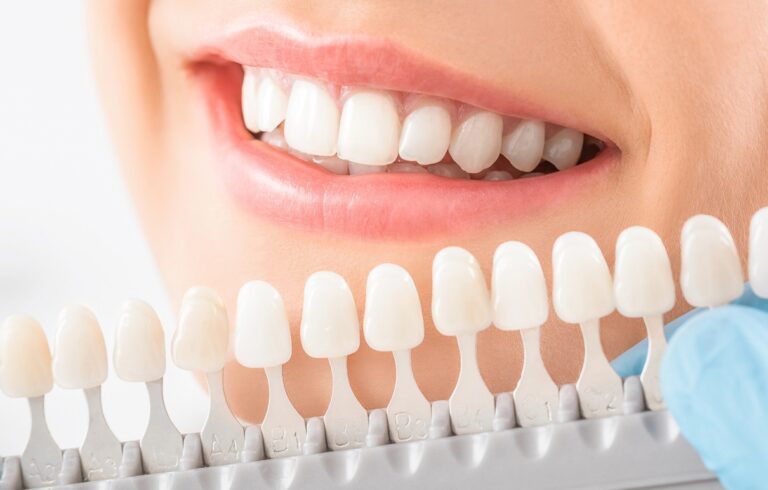 Tooth colored fillings (white fillings) in Lucknow | Mint Dental