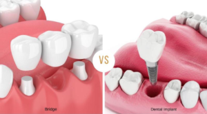 bridge vs dental implant