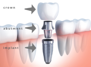 dental implant diagram