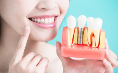 The Last Dental Implant Guide You’ll Ever Need