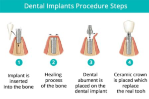 dental implants procedure 