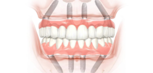 dental implants image