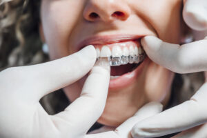 Doctor putting a clear dental aligner to the patient