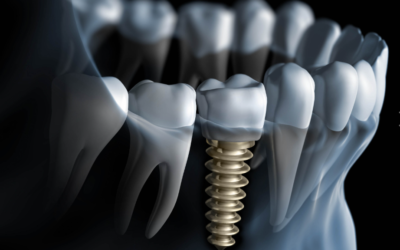 What Are Dental Implants & How Do They Work?
