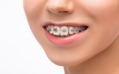 What Are Clear Aligners and How Do They Work?