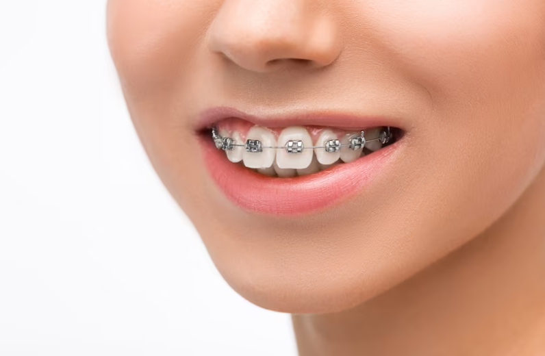 The Step-by-Step Process of Invisalign Braces! »