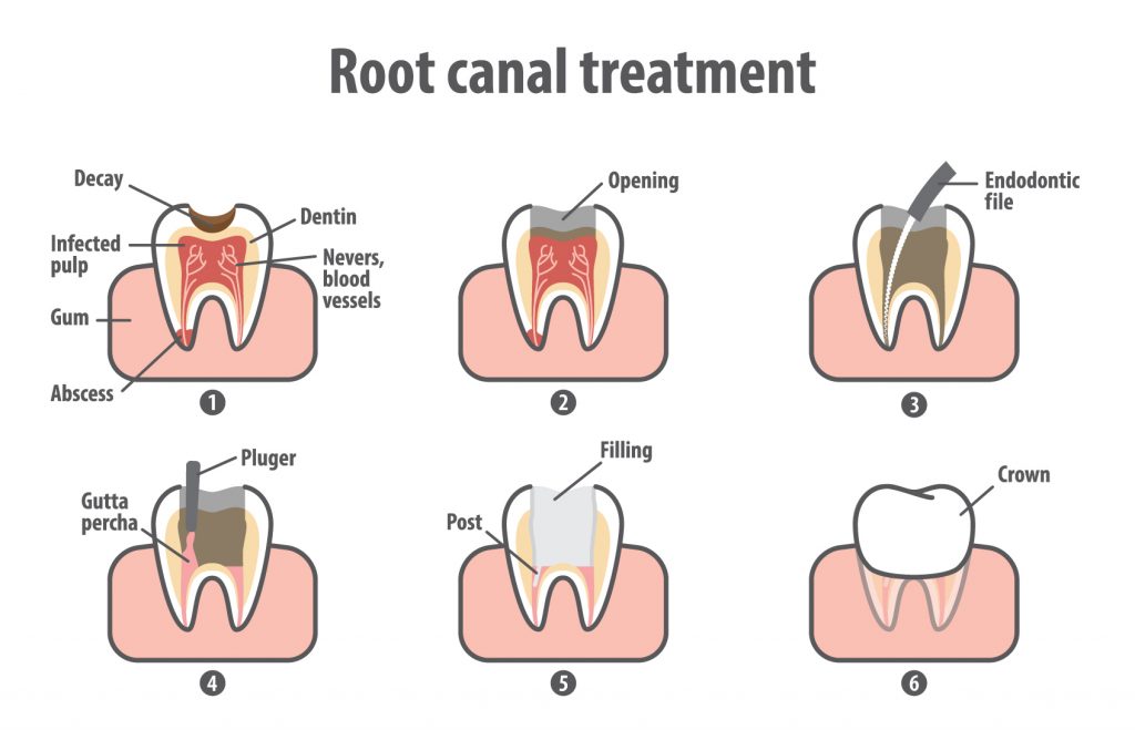 Steps For the Root Canal Treatment