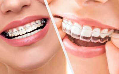 Clear Aligners VS Traditional Braces – Which is best to Use?