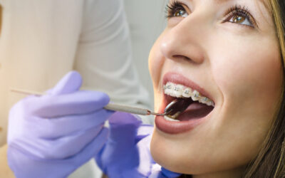Getting a Good Smile With Braces: Myths and Facts