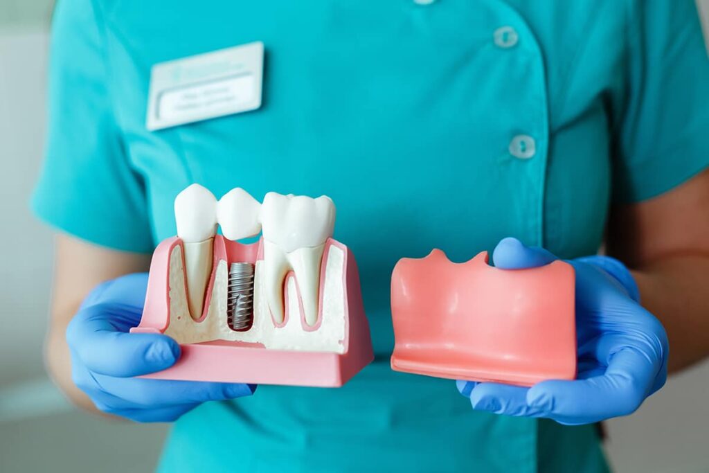 dental implants